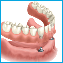 Покрывные зубные протезы на имплантах